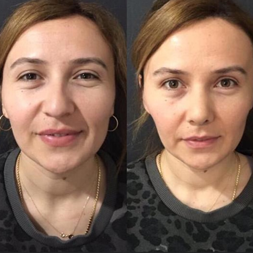  Pendik Burun Estetiği